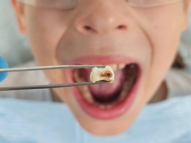Best Emergency Dental Care for Broken or Chipped Teeth in Merriam, KS
